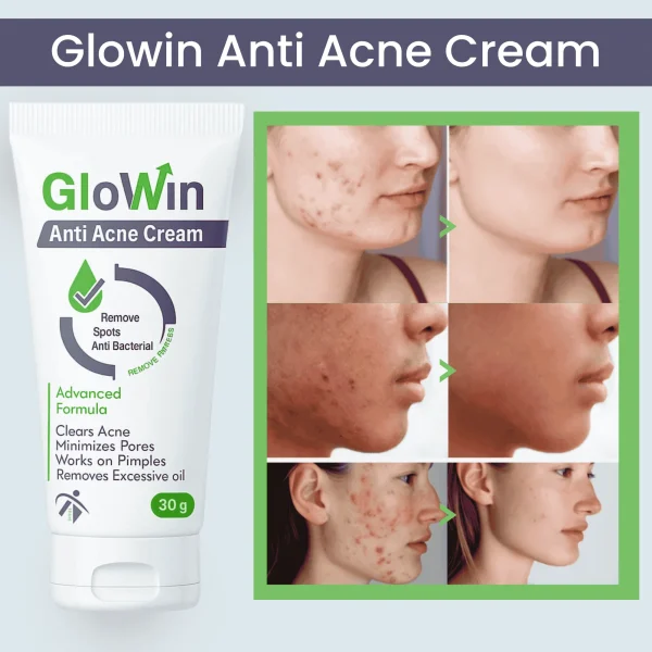 Glowin Anti Acne Cream